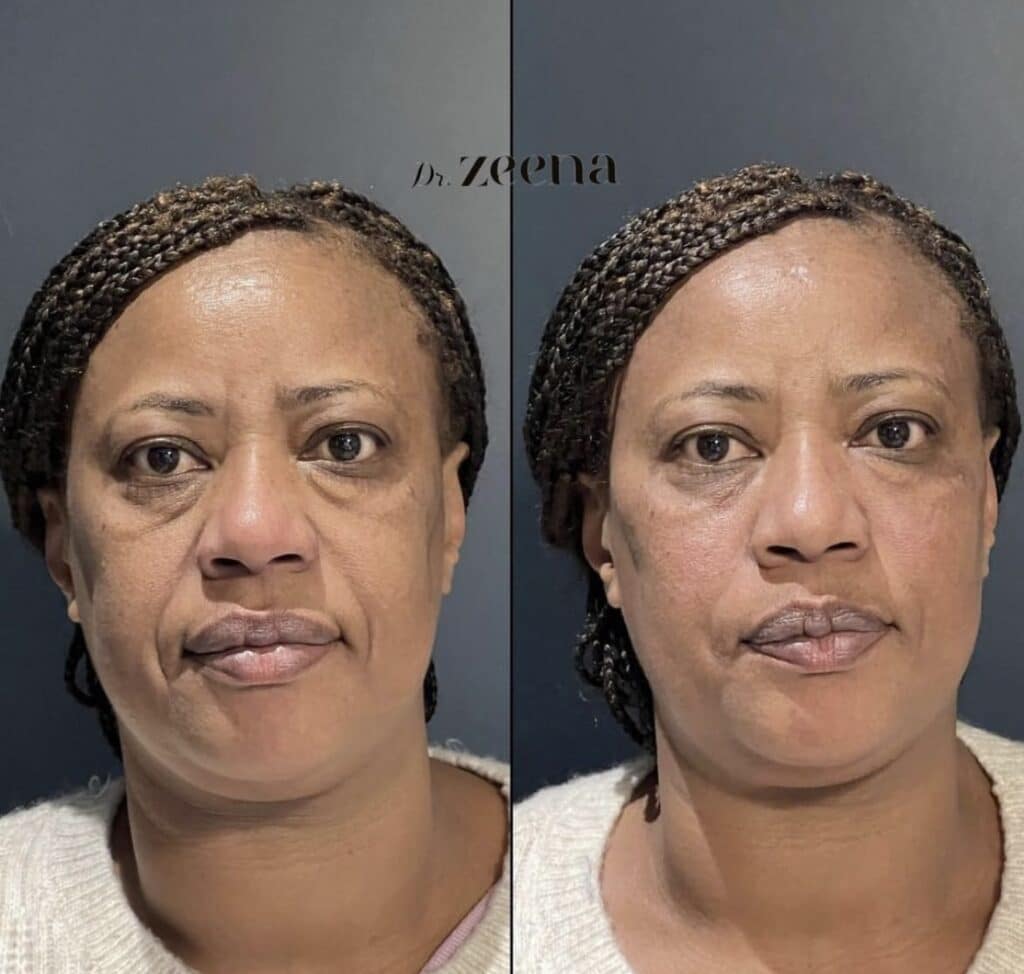 Img 0971 | Dermal Fillers,Fillers