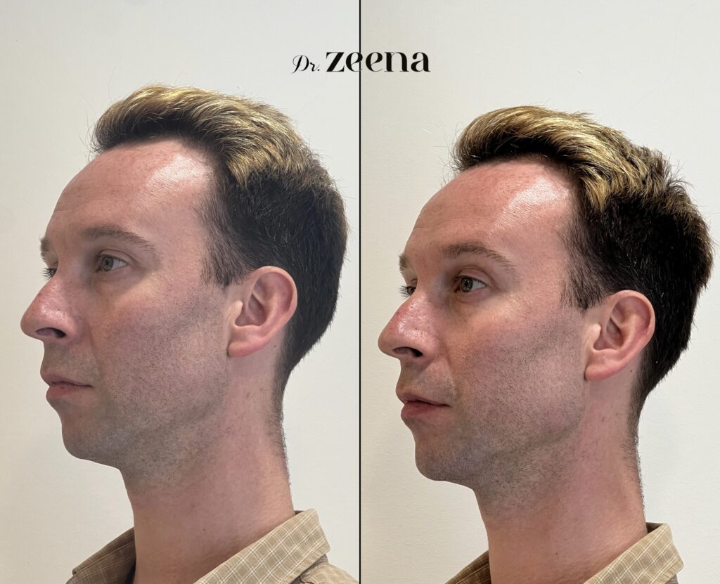 Img 0393 | Dermal Fillers,Fillers