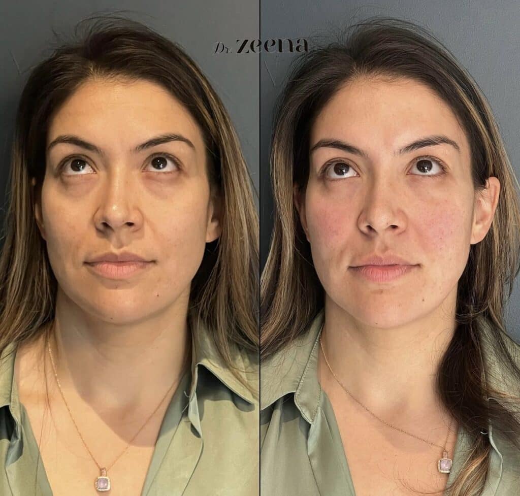Img 0964 | Dermal Fillers,Fillers