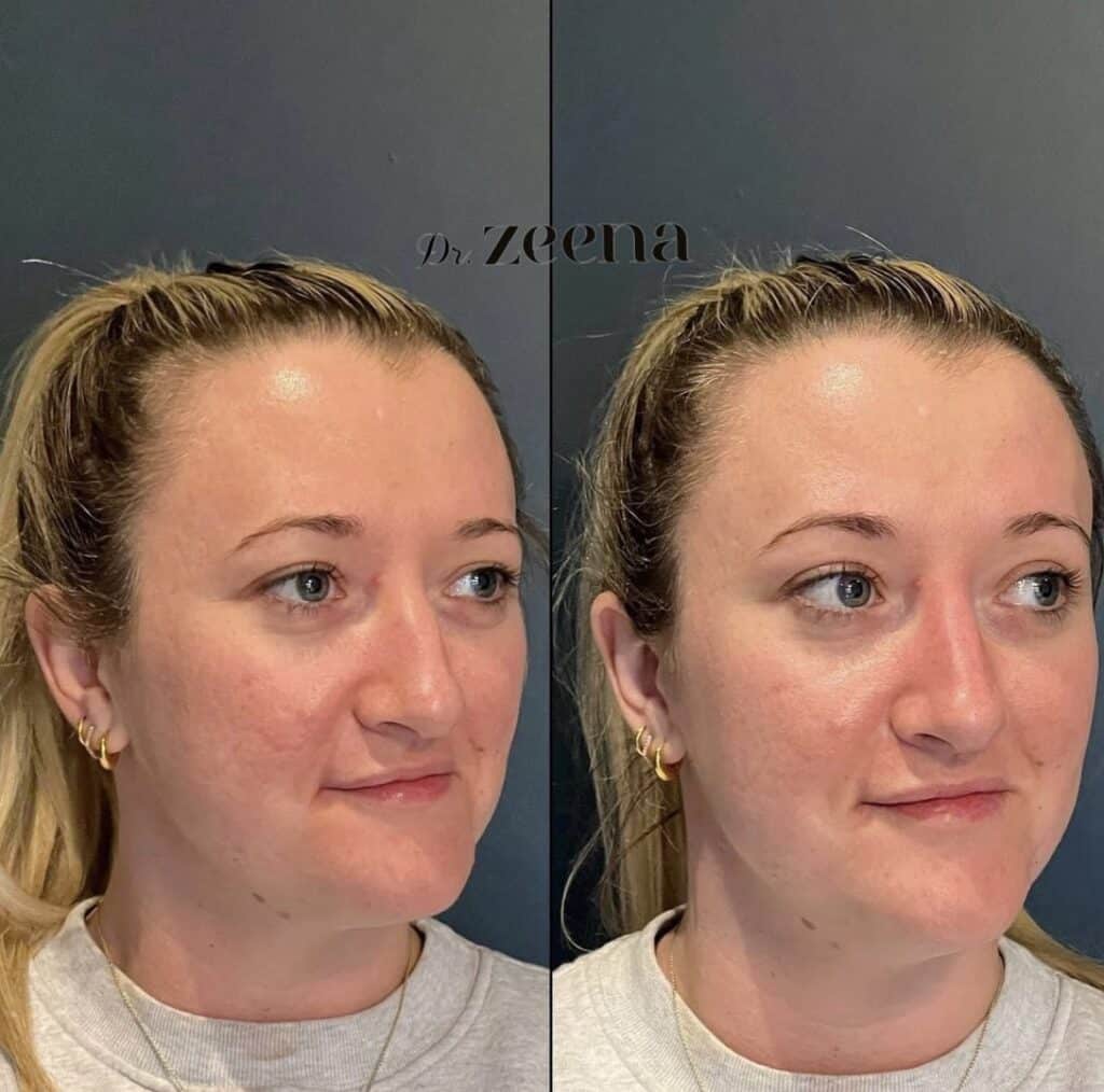 Img 0970 | Dermal Fillers,Fillers