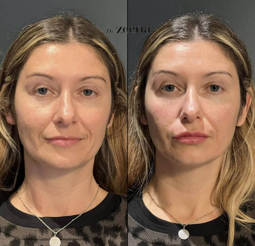 Img 3996 2 | Tear Trough Fillers,Fillers,Tear Trough