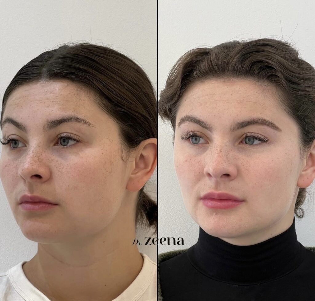 Img 4981 | Dermal Fillers,Fillers