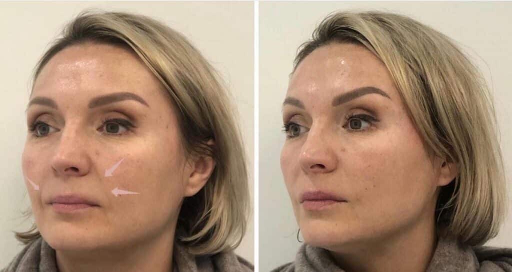 Nasolabial Folds Treatment Before And After