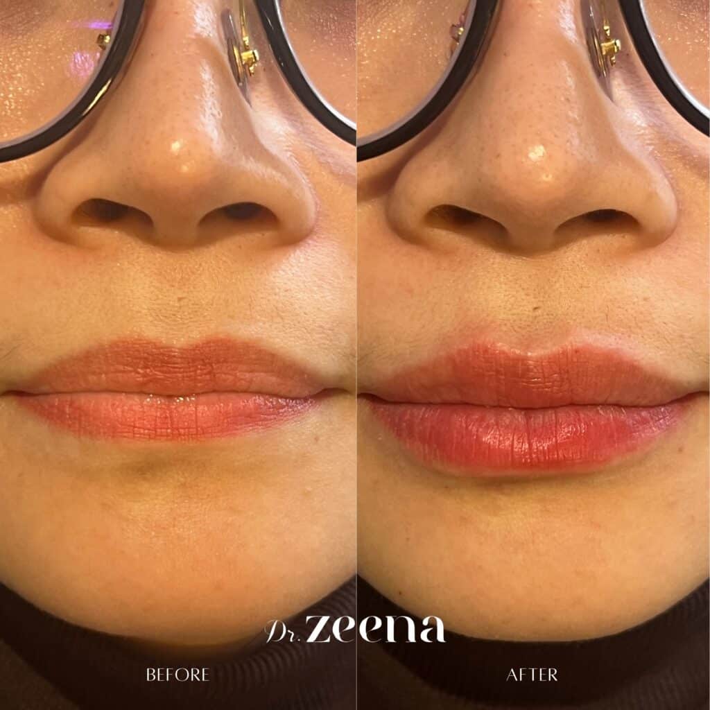 Before And After 1 | Facial Aesthetics Near Me In Chelsea