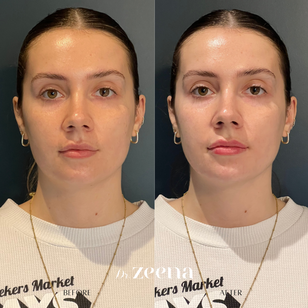 Img 2785 | Facial Aging,Rejuvenation,Aging,Facial,Anti Aging,Aging Solutions,Modern Rejuvenation,Endolift,Rejuvenate,Skin Laxity