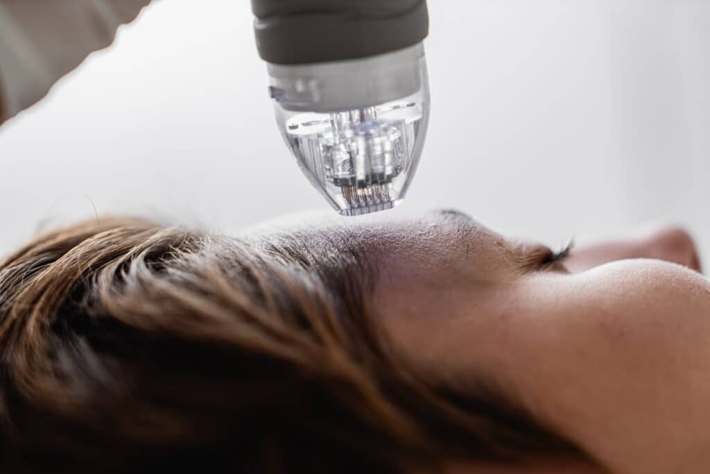 Microneedle Rf Lifting Procedure Hardware Cosmeto 2023 11 27 05 35 50 Utc | Facial Aging,Rejuvenation,Aging,Facial,Anti Aging,Aging Solutions,Modern Rejuvenation,Endolift,Rejuvenate,Skin Laxity