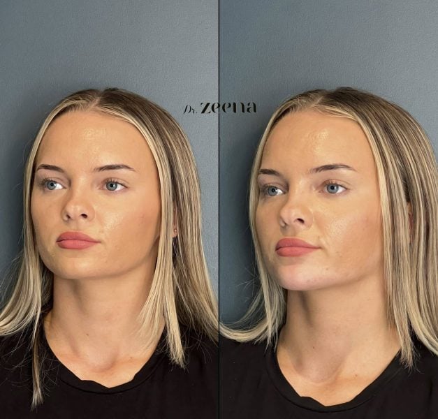 Chin Filler