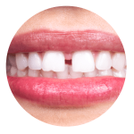 Composite-Bonding_Icon